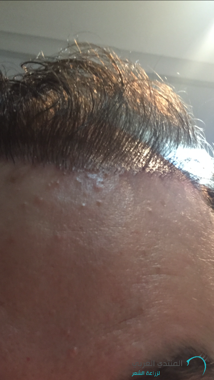 البحث عن حل لازالة الشعر المزروع الصفحة 20 المنتدى العربي لزراعة الشعر وعلاج الصلع