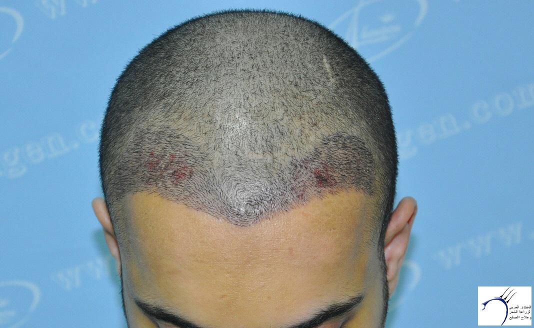 هل يقوم العماري بالدعاية لزراعة الشعر