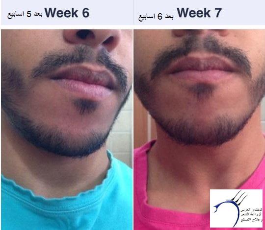 افوجين للذقن