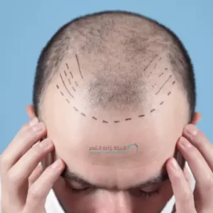 تخطيط الشعر والعناية بالشعر قبل الزرع