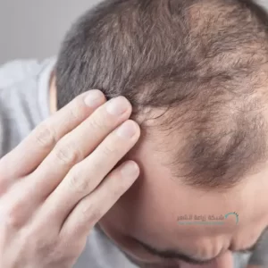 أدوية لعلاج تساقط الشعر لشخص يعانى من تساقط الشعر