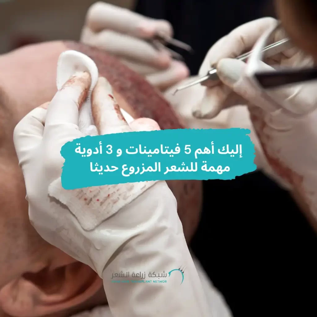 زراعة الشعر وأدوية مهمة للشعر المزروع