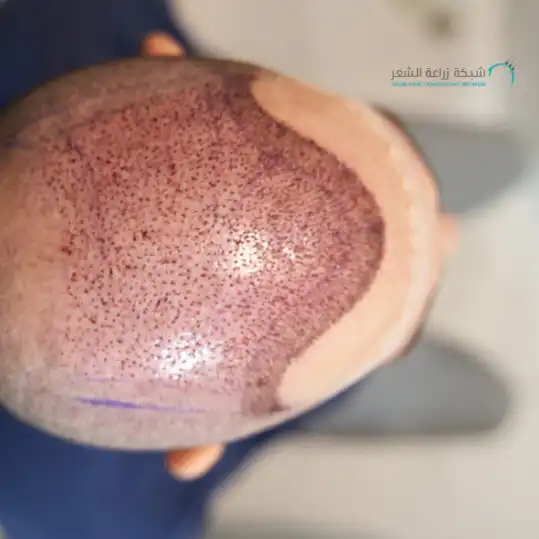 زراعة الشعر وأدوية مهمة للشعر المزروع