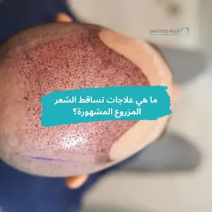 علاجات تساقط الشعر المزروع