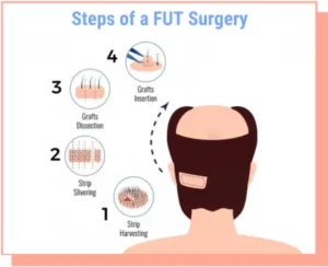 خطوات تقنية الشريحة fut