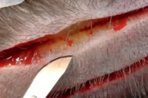 قص الشريحة الجراحية لزراعة الشعر بتقنية الشريحة