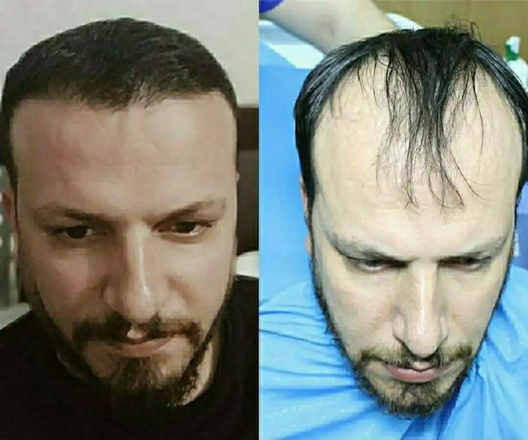رجل يعانى من الصلع الامامي قبل وبعد إجراء عملية زراعة الشعر فى مركز رويال هير بلاس