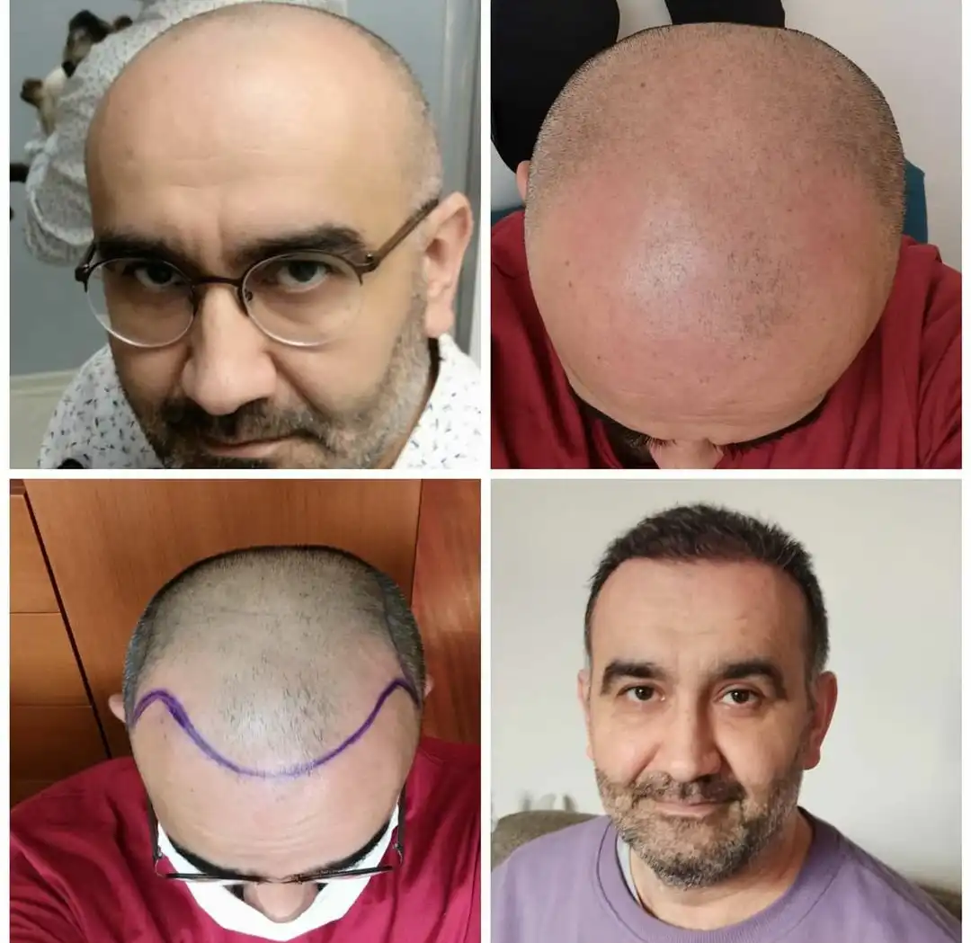 رجل يعانى من الصلع الكلي قبل وبعد إجراء عملية زراعة الشعر فى مركز رويال هير بلاس