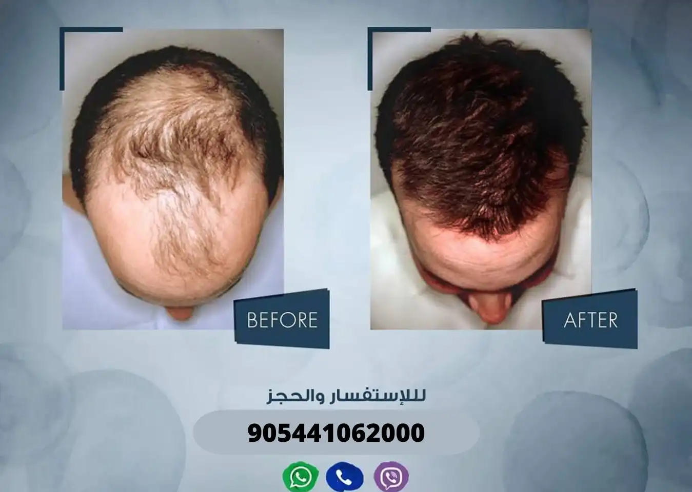 رجل يعاني من الصلع الأمامي قبل وبعد إجراء عملية زراعة الشعر في مركز آرت لزراعة الشعر