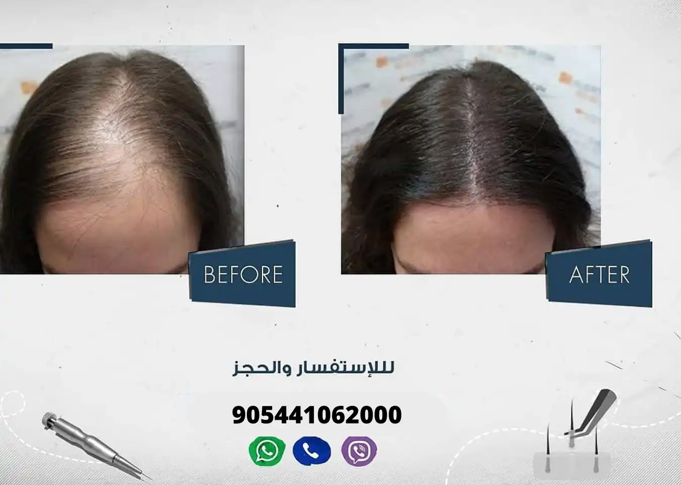 سيدة تعاني من الصلع الأمامي قبل وبعد إجراء عملية زراعة الشعر في مركز آرت لزراعة الشعر