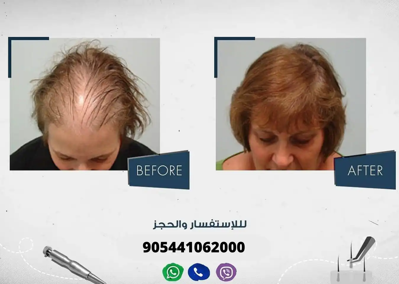 سيدة تعاني من الصلع قبل وبعد إجراء عملية زراعة الشعر في مركز آرت لزراعة الشعر