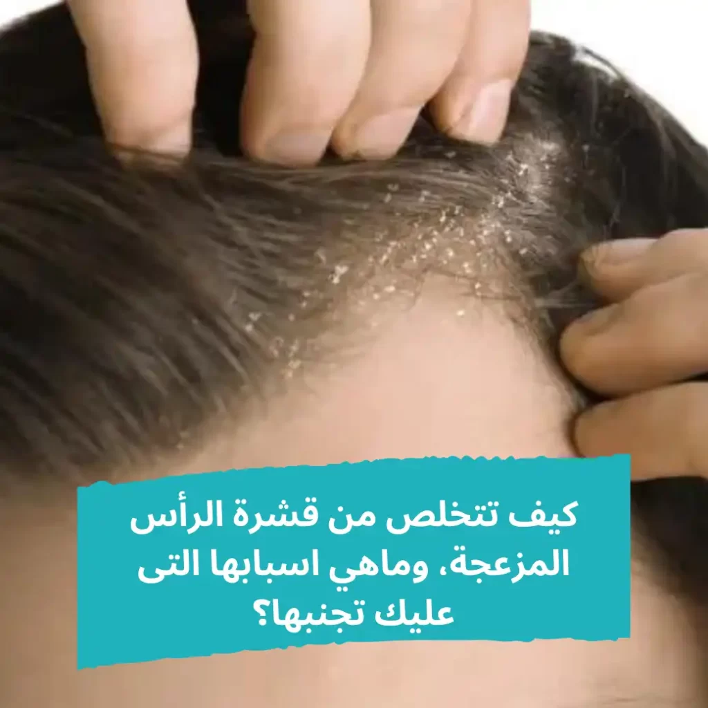 قشرة الرأس- الشبكة العربية لزراعة الشعر