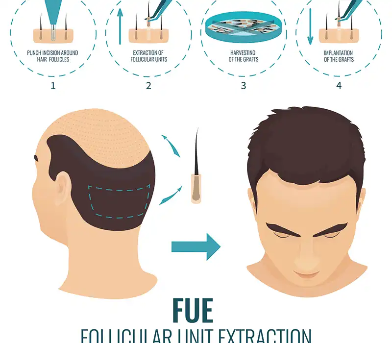 جرافك يشرح زراعة الشعر بتقنية الاقتطاف FUE