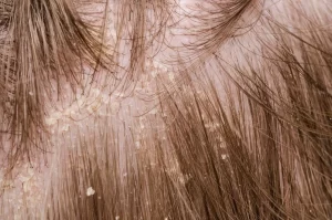 قشرة الرأس- الشيكة العربية لزراعة الشعر