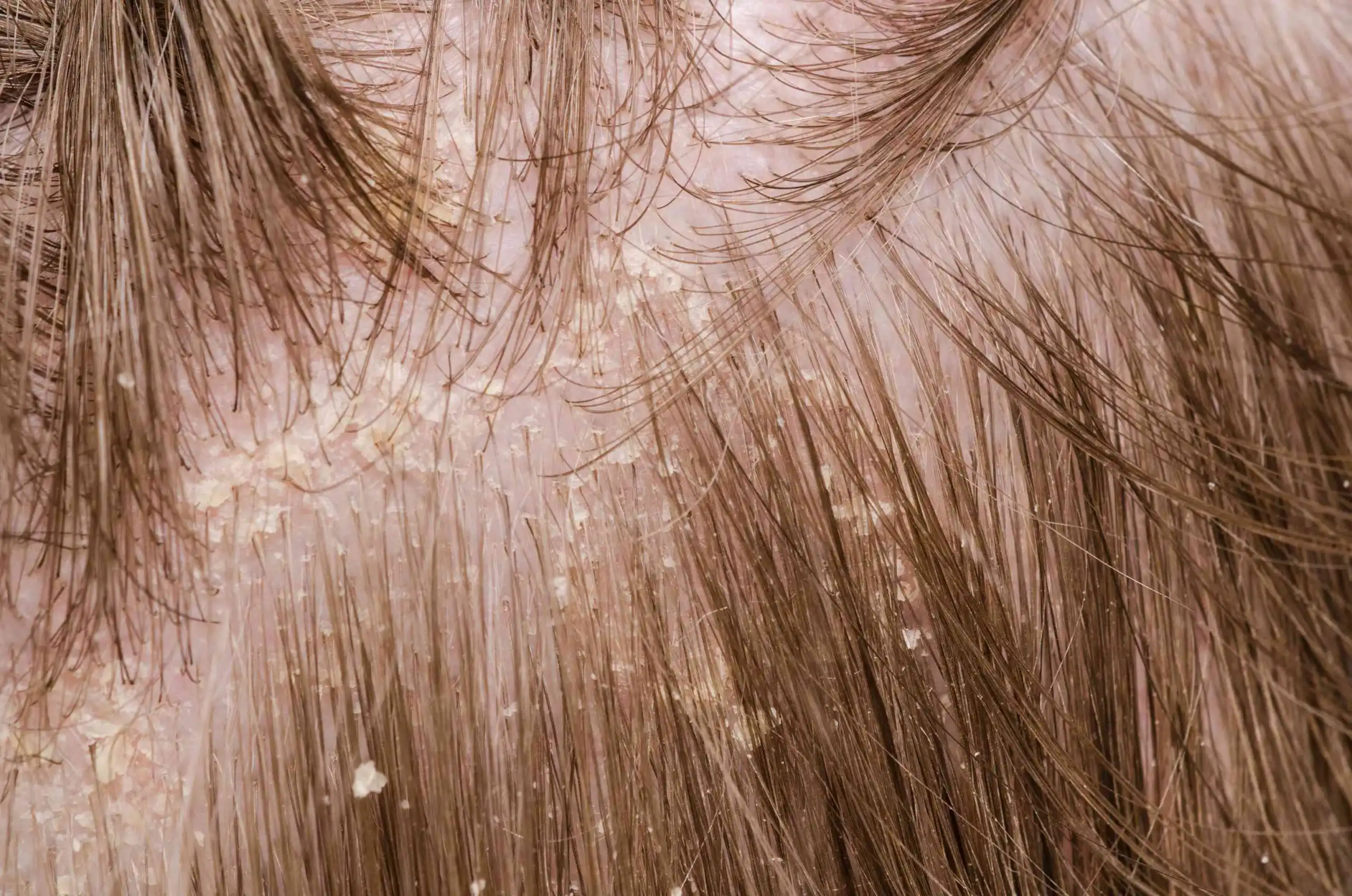 قشرة الرأس- الشيكة العربية لزراعة الشعر