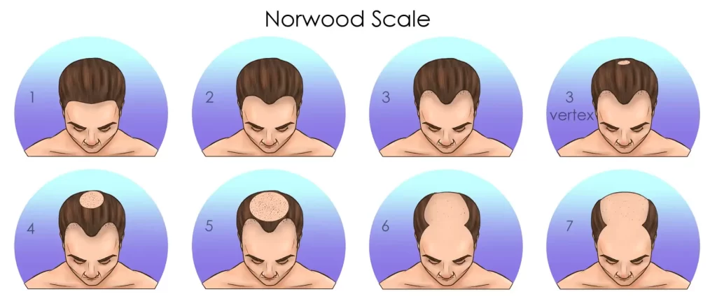 مراحل تشكل الصلع الوراثي norwood scale