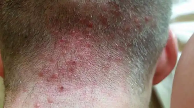 التهاب الجريبات على الذقن من أمراض فروة الرأس - الشبكة العربية لزراعة الشعر