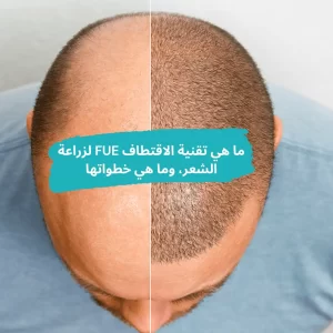 زراعة الشعر بتقنية الاقتطاف FUE