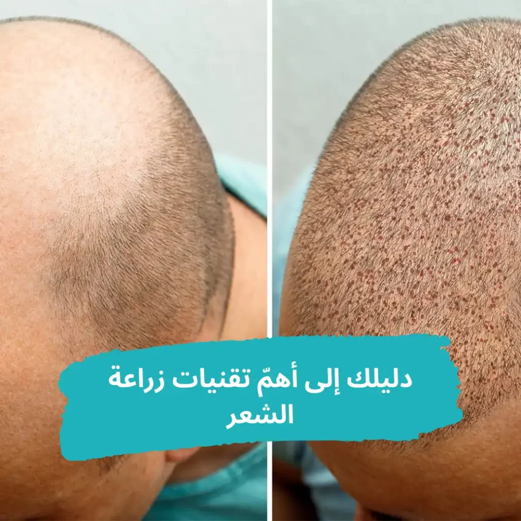 دليلك إلى أهم تقنيات زراعة الشعر -الشبكة العربية لزراعة الشعر