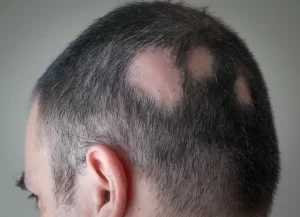 سعفة الرأس من أمراض فروة الرأس - الشبكة العربية لزراعة الشعر