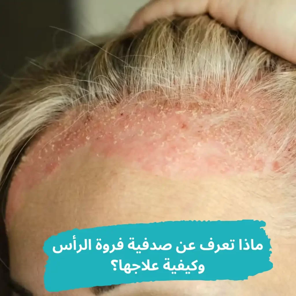 سيدة تعانى من صدفية فروة الرأس - الشبكة العربية لزراعة الشعر