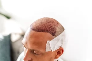 شخص قام بزراعة لشعر باستخدام تقنيات زراعة الشعر الحديثة