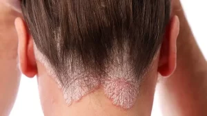 شخص يعانى من صدفية فروة الرأس - الشبكة العربية لزراعة الشعر