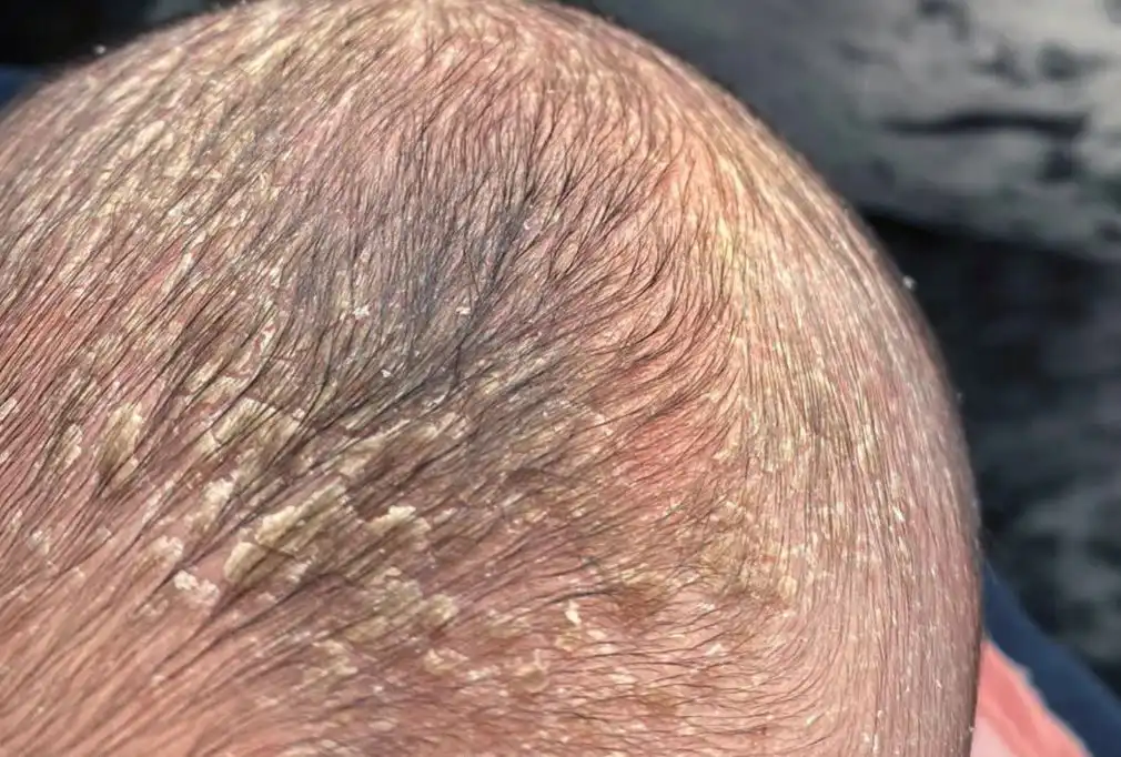 طقية المهد أحد أمراض فروة الرأس -الشبكة العربية لزراعة الشعر