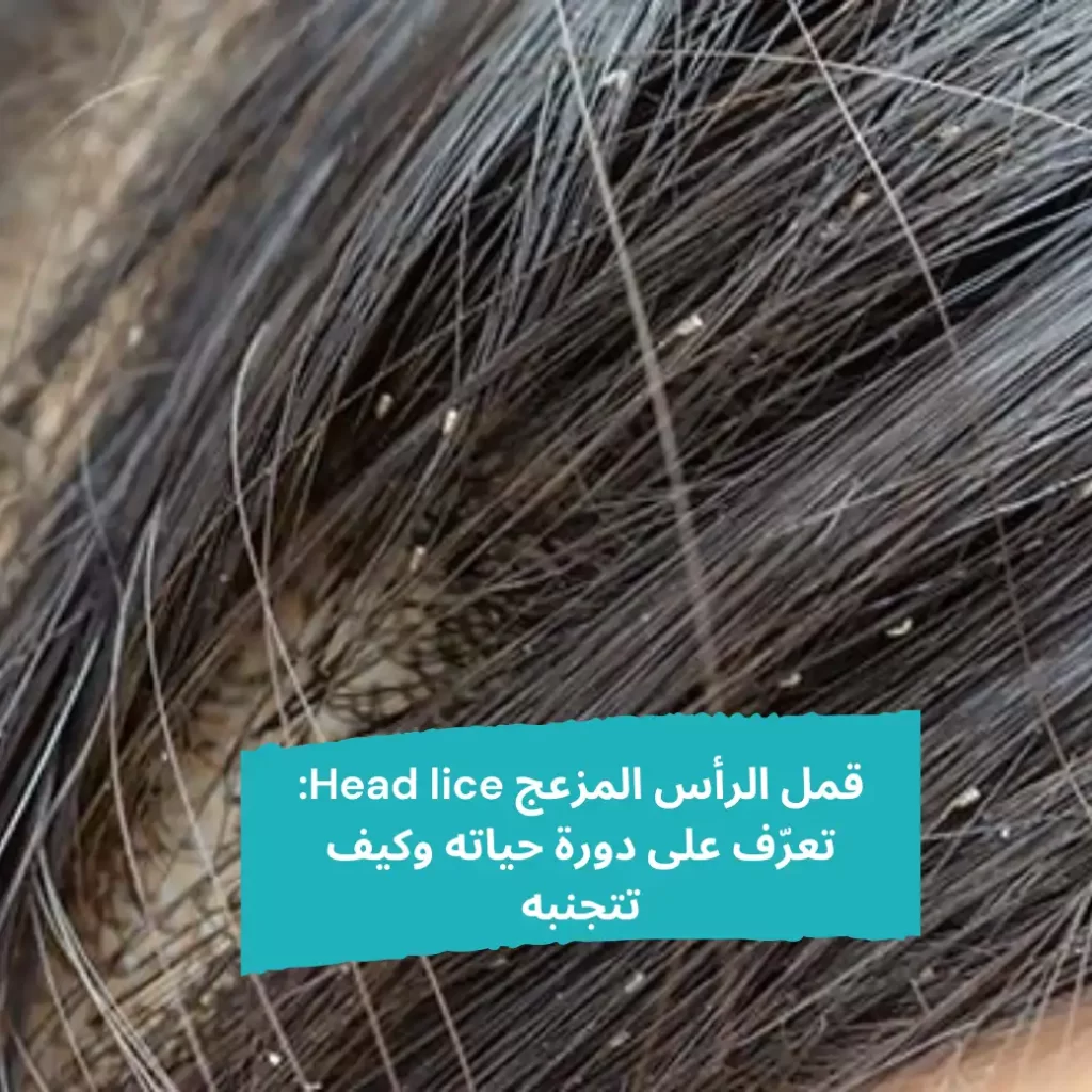 قمل الرأس المزعج Head lice تعرّف على دورة حياته وكيف تتجنبه