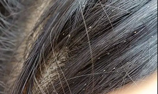 قمل الرأس من أمراض فروة الرأس - الشبكة العربية لزراعة الشعر