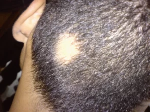 مرض الثعلبة لدى الرجال أحد أمراض فروة الرأس - الشبكة العربية لزراعة الشعر