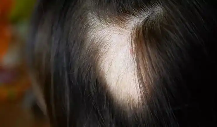 مرض الثعلبة لدى النساء أحد أمراض فروة الرأس - الشبكة العربية لزراعة الشعر