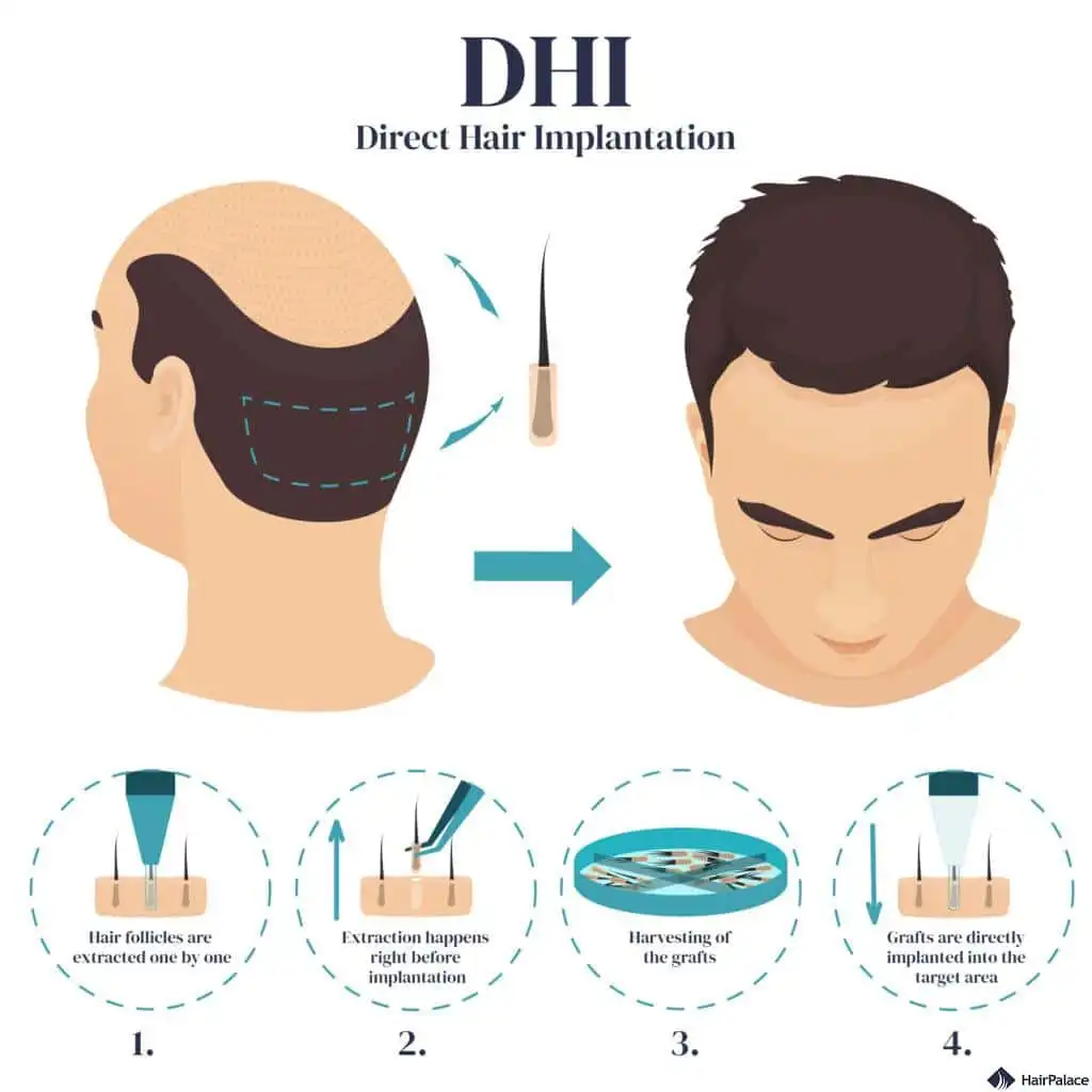 جرافك يشرح عملية زراعة الشعر بتقنية أقلام تشوي DHI
