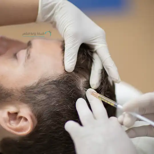 حقن شعر شاب لاستعادة الشعر بالبلازما - الشبكة العربية لزراعة الشعر