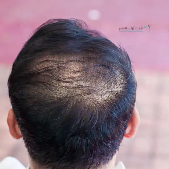 رأس رجل يعانى من تساقط الشعر الوراثي