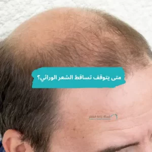 رأس رجل يعاني من تساقط الشعر الوراثي.