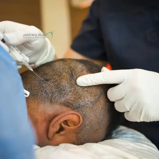 راس رجل يقوم الطبيب بحقنها استعدادا لزراعة الشعر في السعودية