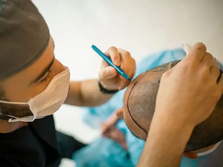 راس شخص نصفها اصلع والنص الاخر حدث له زراعة الشعر في السعودية