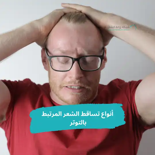 رجل يرتدى تيشيرت احمر ويضع يده على راسه بسبب التوتر وأنواع تساقط الشعر المرتبط بالتوتر 