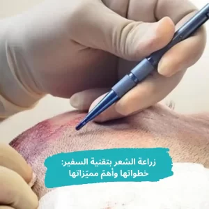 زراعة الشعر بتقنية السفير خطواتها وأهمّ مميّزاتها