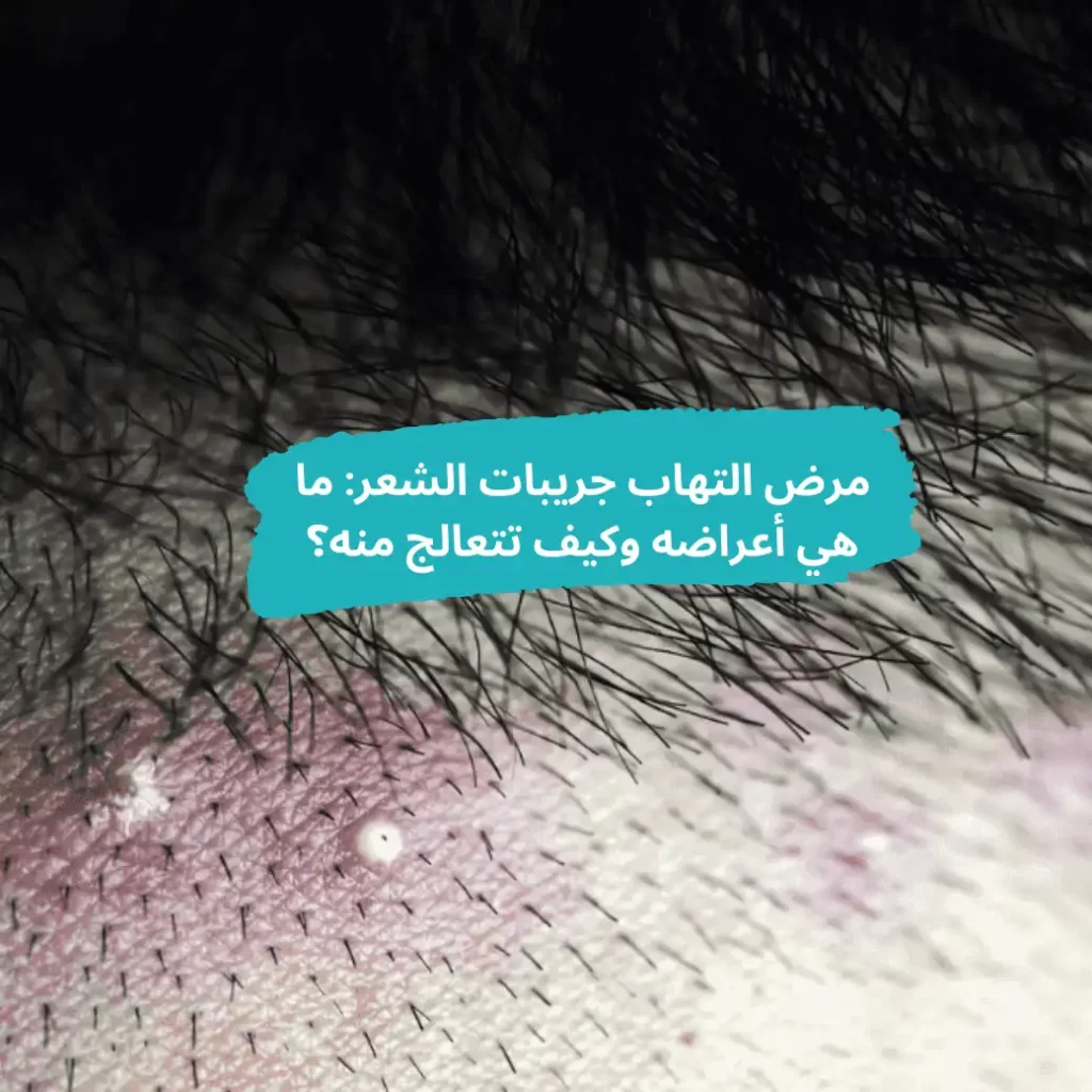 شخص يعانى من مرض التهاب جربيات الشعر - الشبكة العربية لزراعة الشعر