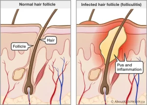 شرح لكيفية حدوث التهاب جريبات الشعر - الشبكة العربية لزراعة الشعر