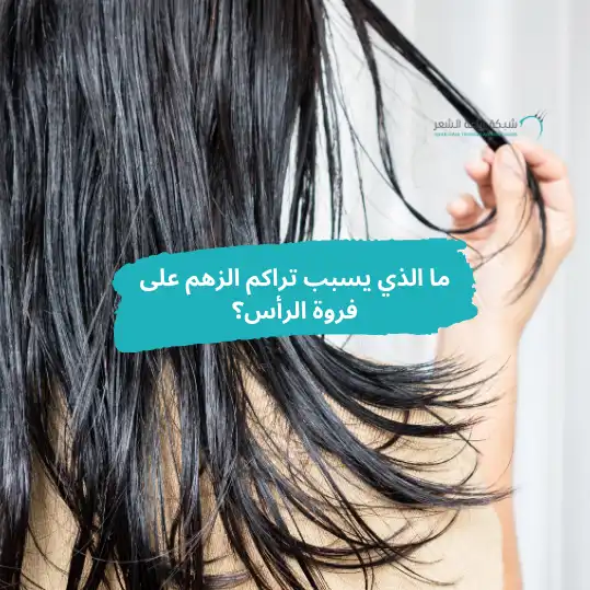 شعر دهنى وما الذى يسبب تراكم الزهم على فروة الرأس - الشبكة العربية لزراعة الشعر