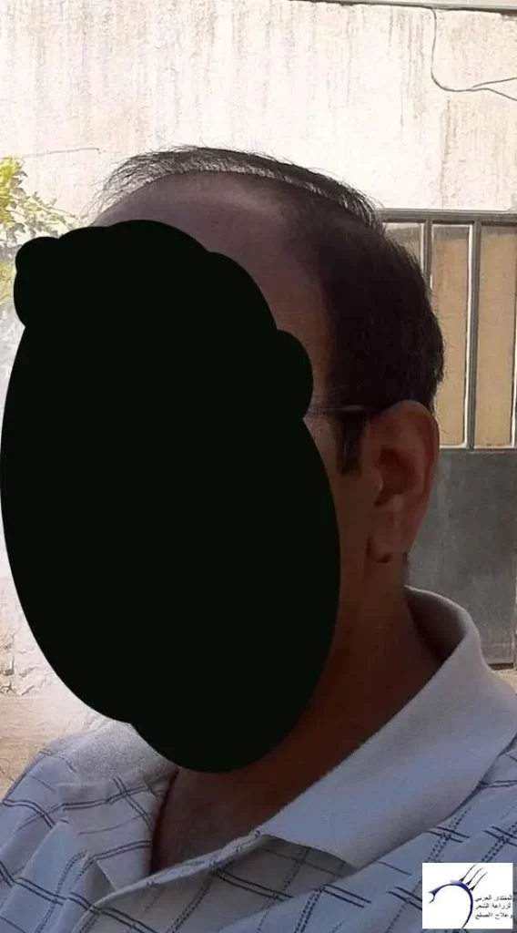 مريض يعانى من الصلع الجزئي قبل إجراء عملية زراعة الشعر وتجربتي في زراعة الشعر في السعودية مركز ادمه دكتور يوسف الخير