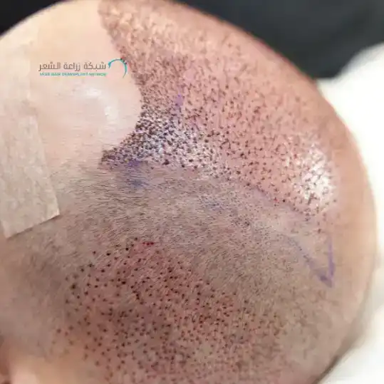 زراعة الشعر في السعودية