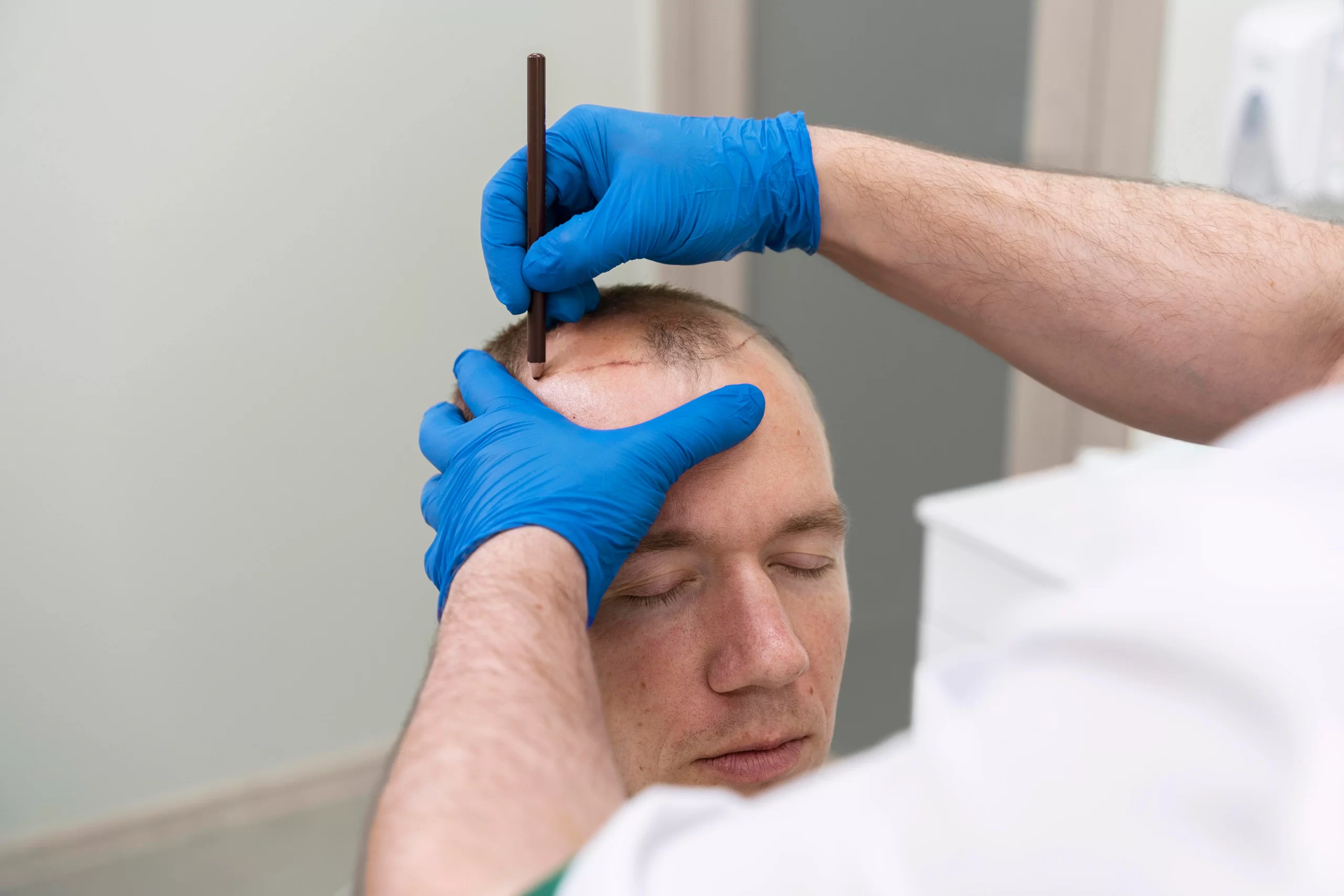طبيب يقوم بتحديد المناطق للقيام بزراعة الشعر في السعودية