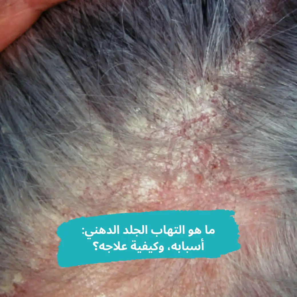 فروة رأس شخص يعانى من التهاب الجلد الدهني بدرجة كبيرة