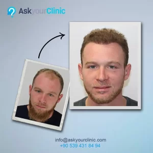 حالة صلع قبل وبعد إجراء عملية زراعة الشعر في مركز Ask Your Clinic