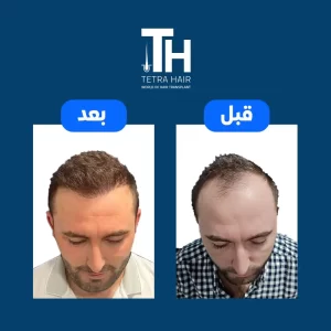 صور حالة صلع أمامى قبل وبعد العملية فى مركز تيترا هير لزراعة الشعر