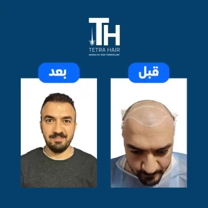 صور حالة صلع قبل وبعد عملية زراعة الشعر فى مركز تيترا هير لزراعة الشعر